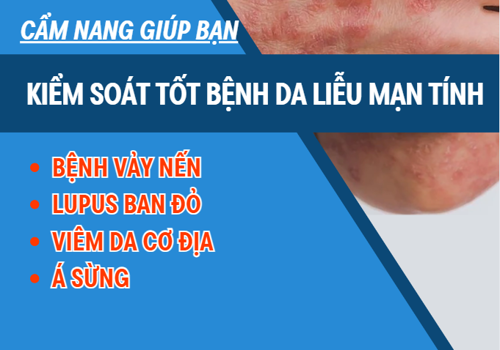 Bí quyết kiểm soát bệnh vảy nến, viêm da, lupus ban đỏ hiệu quả